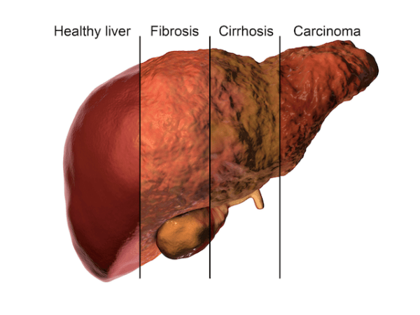 Cirrhosis
