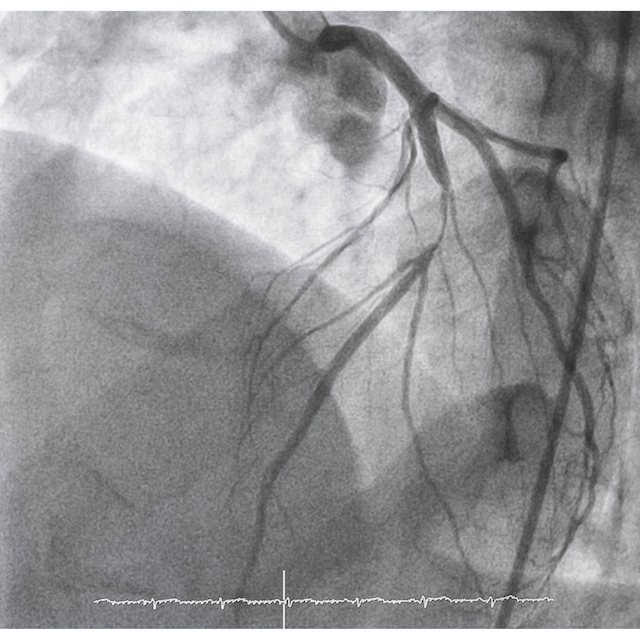 Acute Coronary Syndrome&nbsp;(ACS)