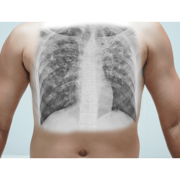 Acute Respiratory Distress Syndrome&nbsp;(ARDS)