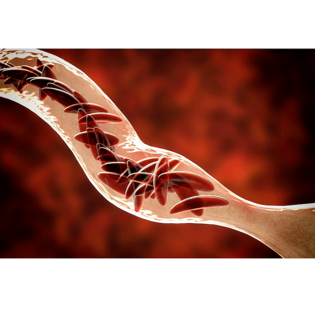 Sickle Cell