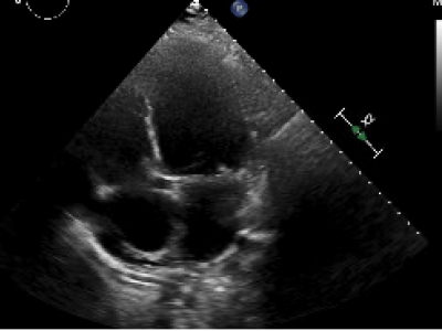 Heart Failure (Outpatient)