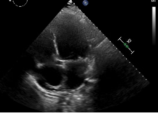 Heart Failure (Outpatient)